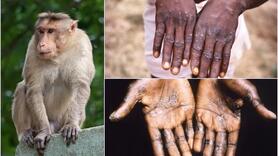 Bệnh đậu mùa khỉ khi mang thai: Dấu hiệu, triệu chứng
