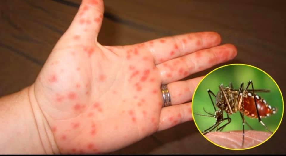 Đã có hơn 124.000 ca mắc, 40 người tử vong do sốt xuất huyết; dấu hiệu nguy hiểm của bệnh - Ảnh 1.