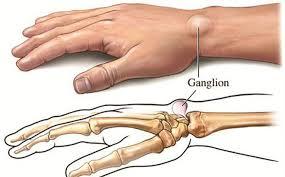 Những yếu tố nguy cơ nào dẫn đến nang bao hoạt dịch cổ tay? - Ảnh 1.