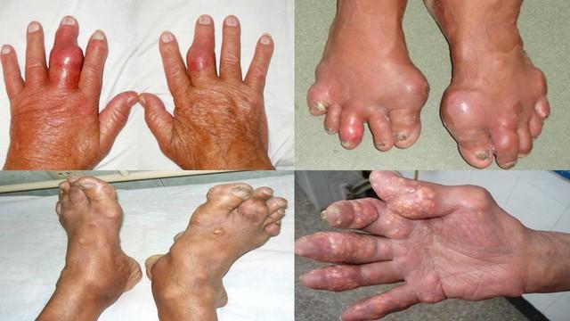 Bệnh gout có những biến chứng nguy hiểm mà nhiều người chưa biết - Ảnh 1.
